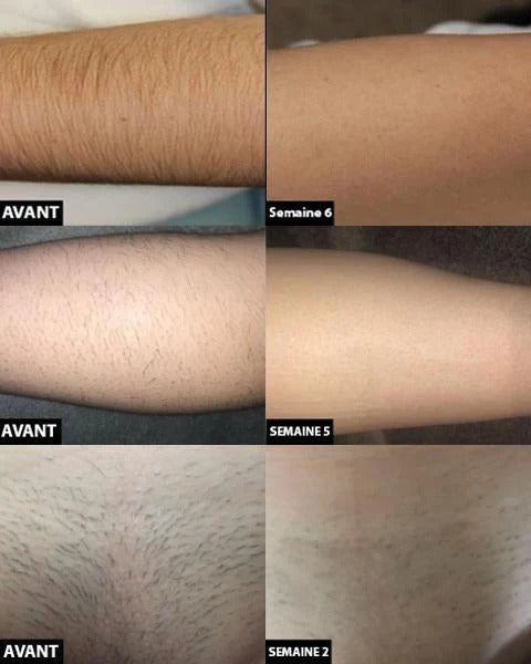 Automatic Hair Removal Instrument